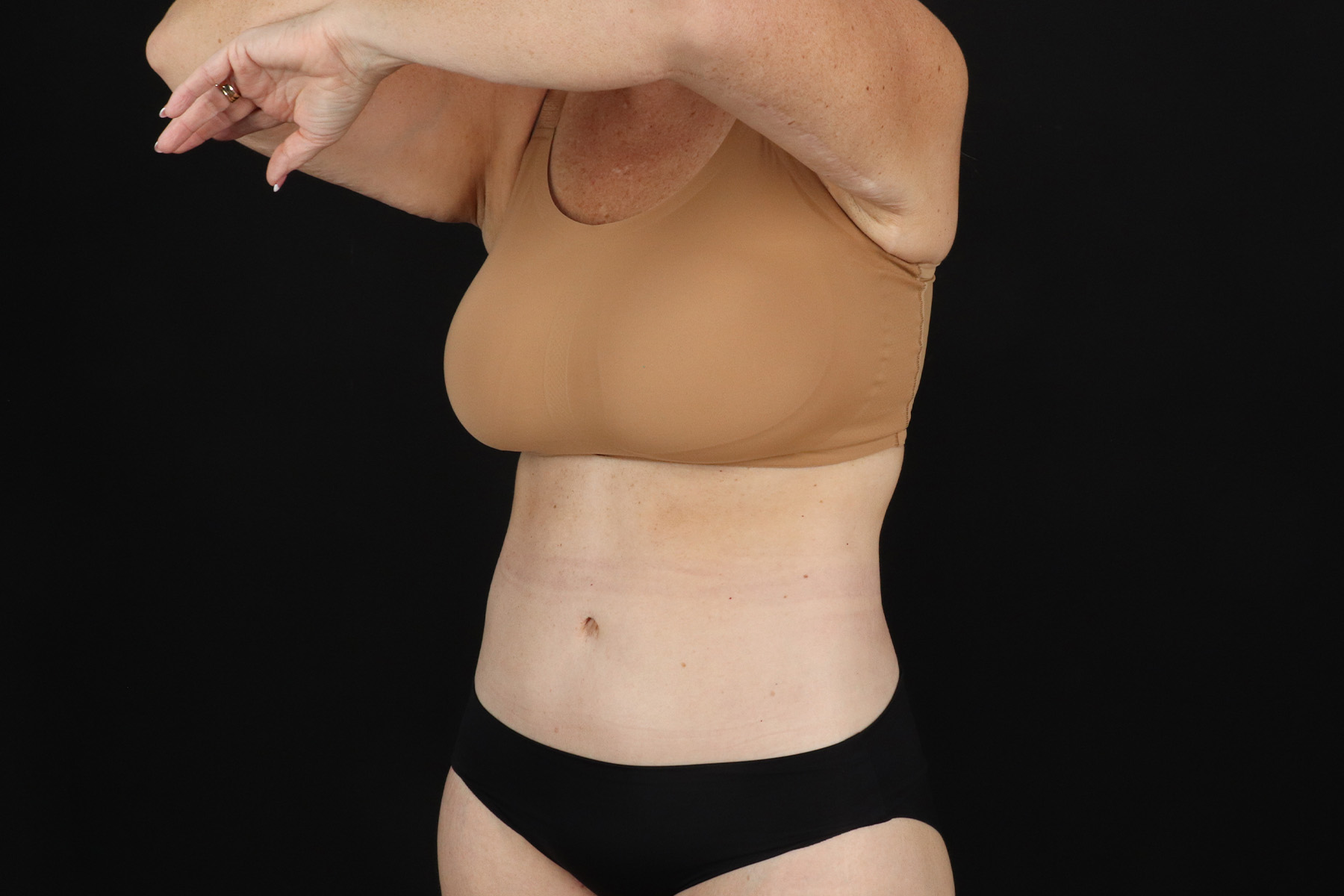 Circumferential Body Lift Before & After Patient #4500