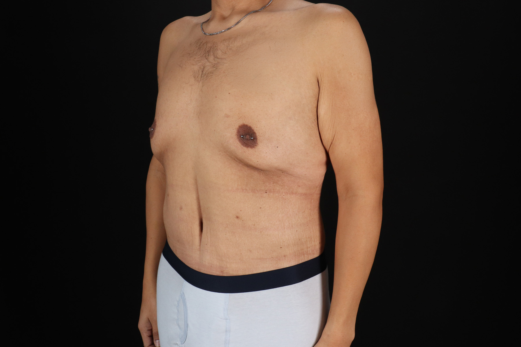 Circumferential Body Lift Before & After Patient #4497