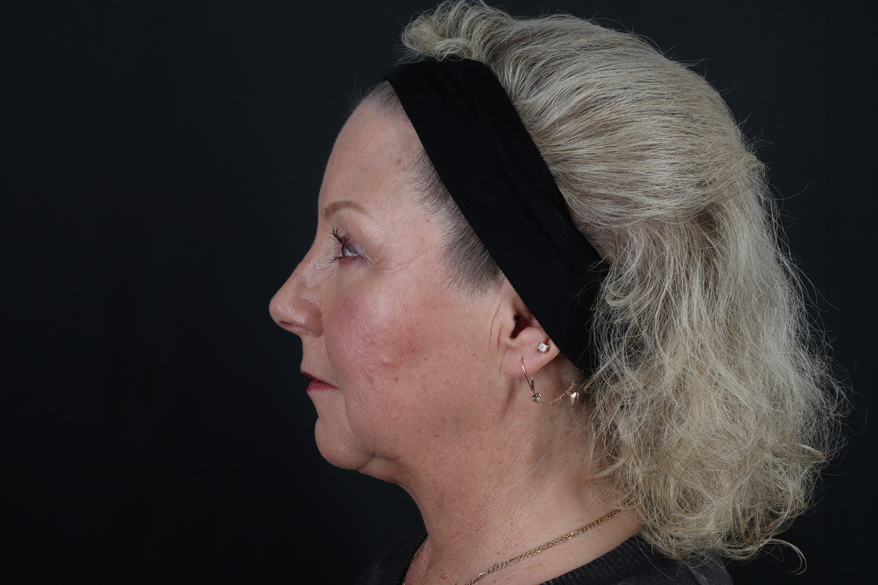 Face & Neck Lift Before & After Patient #4693