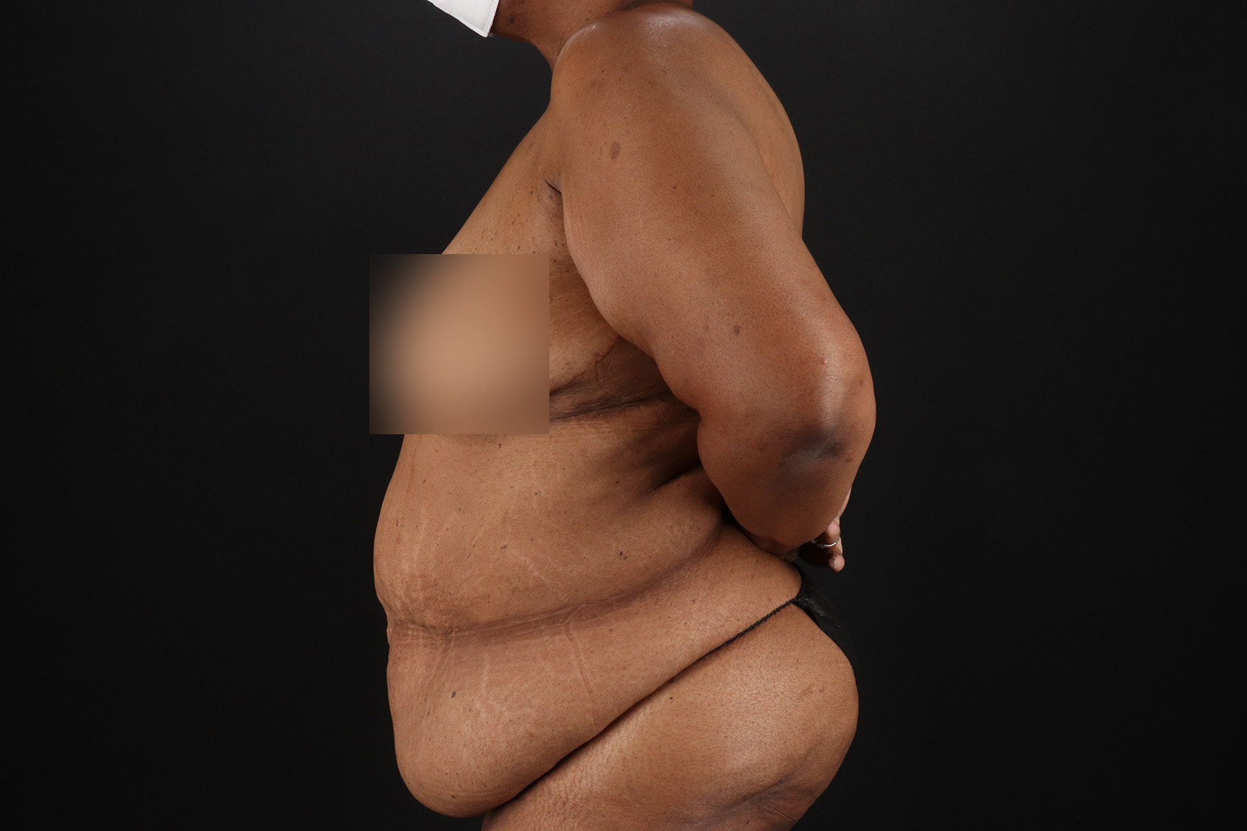Circumferential Body Lift Before & After Patient #4494
