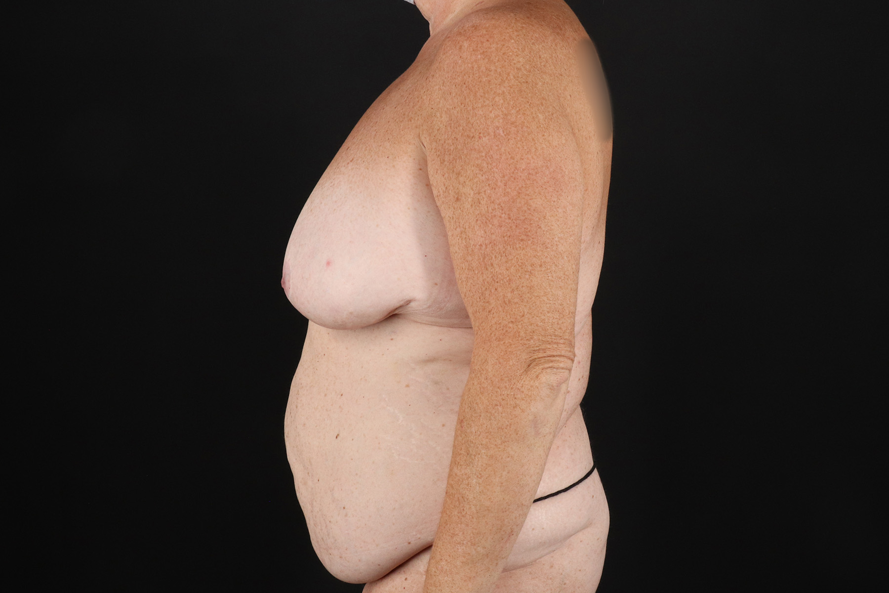 Circumferential Body Lift Before & After Patient #4496