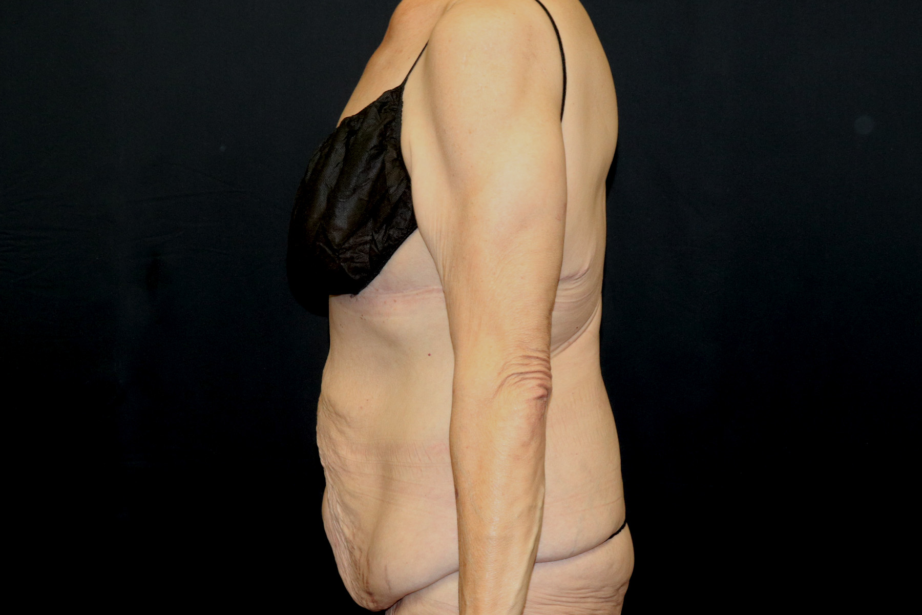 Circumferential Body Lift Before & After Patient #4495