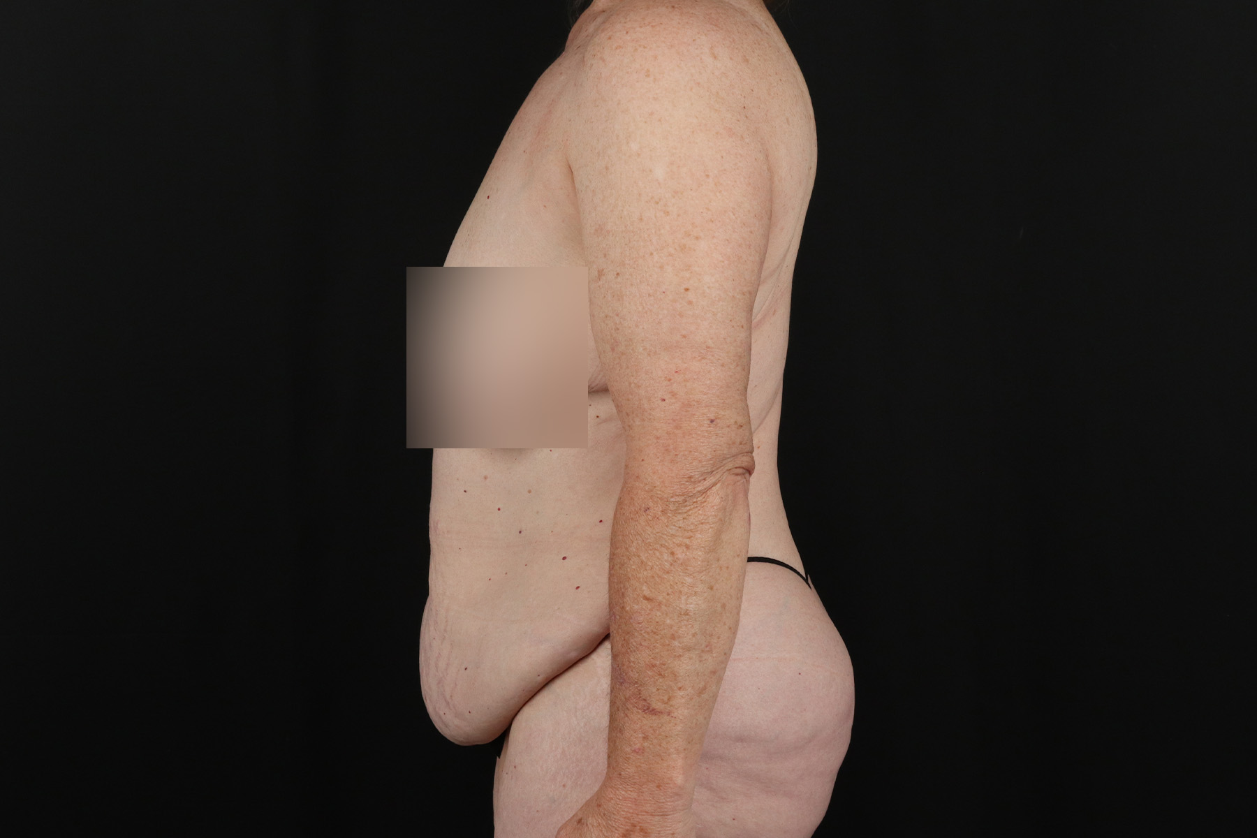 Circumferential Body Lift Before & After Patient #4490