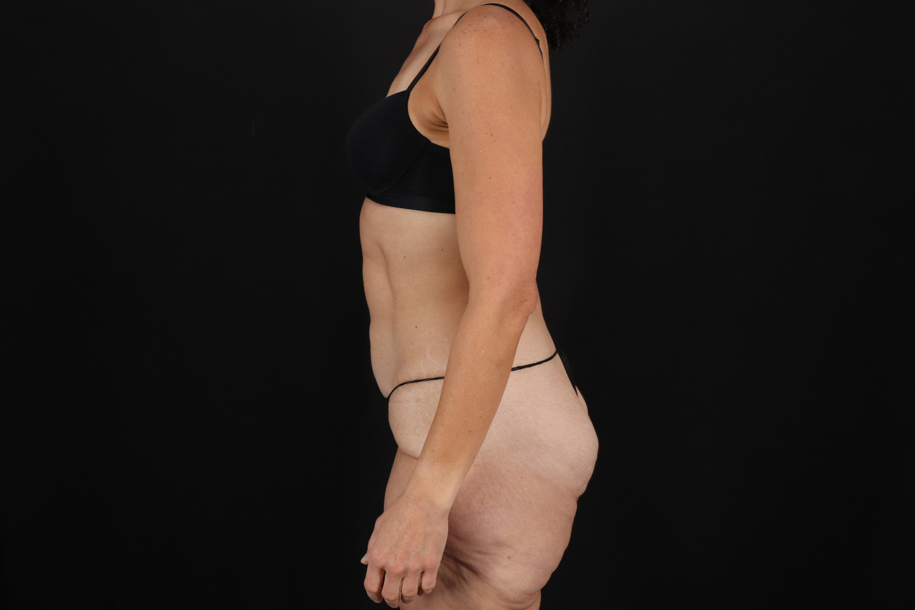 Circumferential Body Lift Before & After Patient #4493