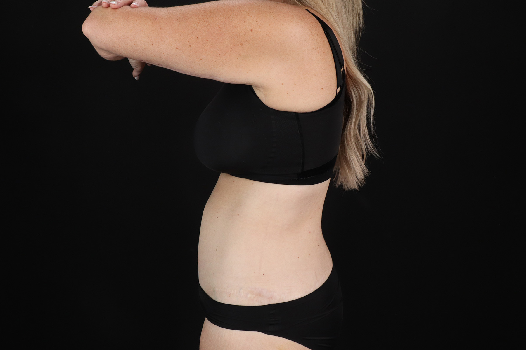 Circumferential Body Lift Before & After Patient #4500
