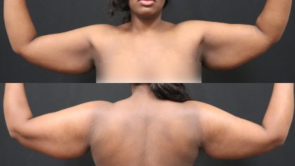 Arm Lift Before & After Patient #4797