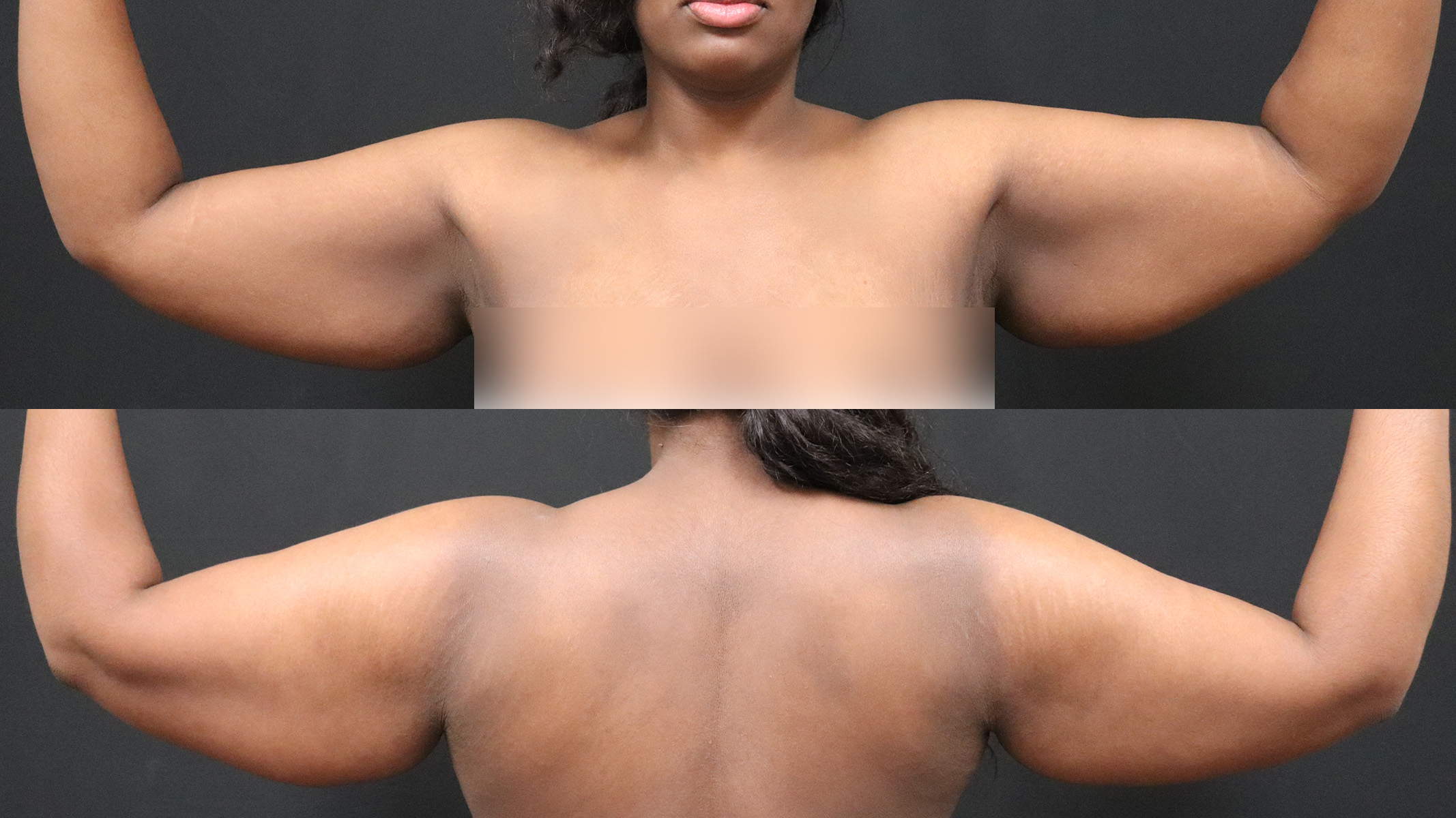Arm Lift Before & After Patient #4797