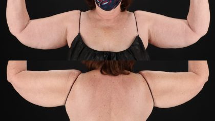 Arm Lift Before & After Patient #4750