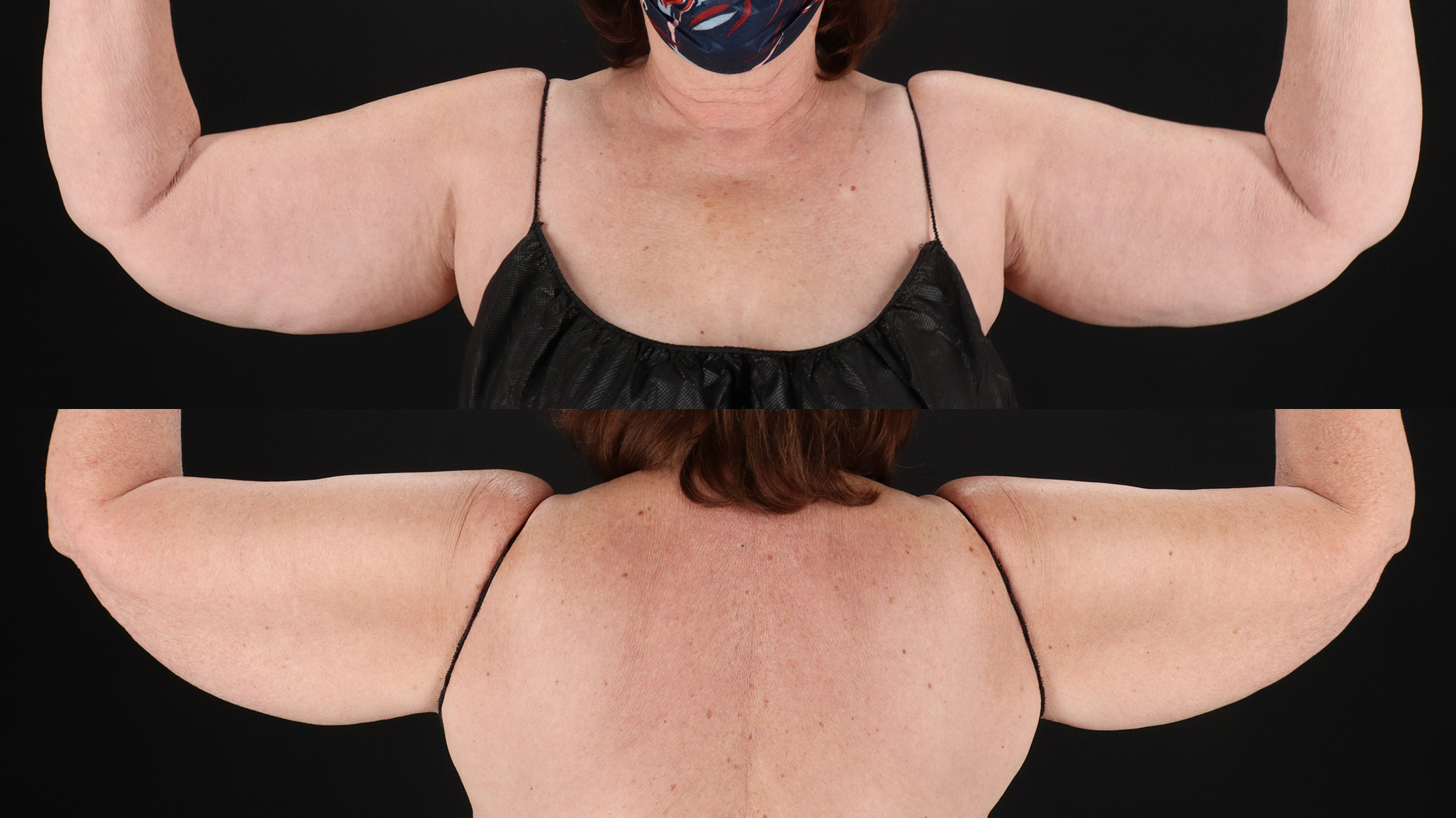 Arm Lift Before & After Patient #4750