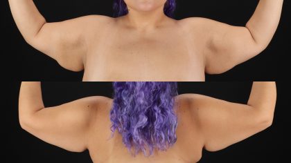 Arm Lift Before & After Patient #4796