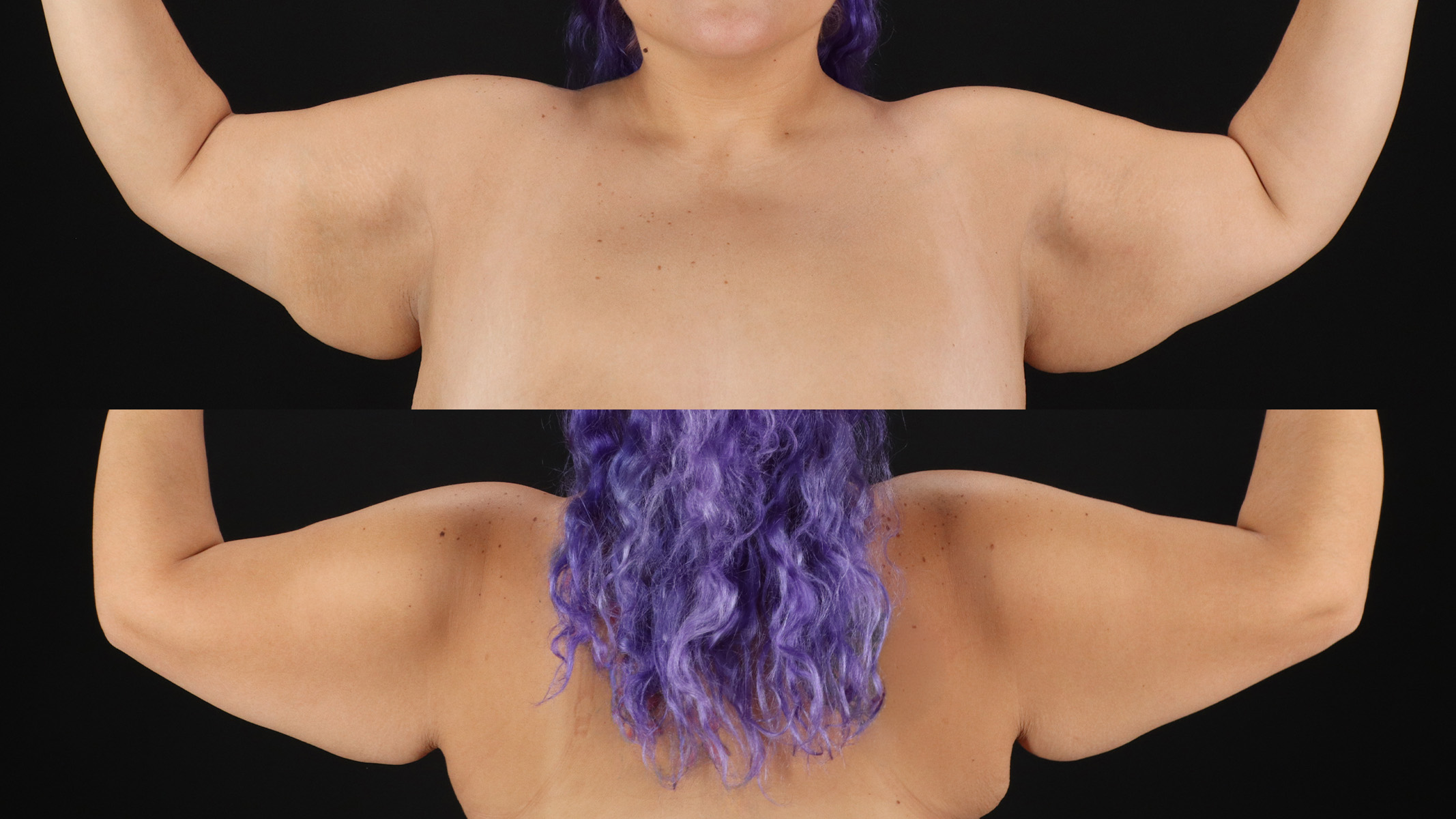 Arm Lift Before & After Patient #4796