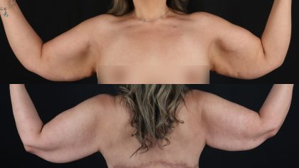 Arm Lift Before & After Patient #4821