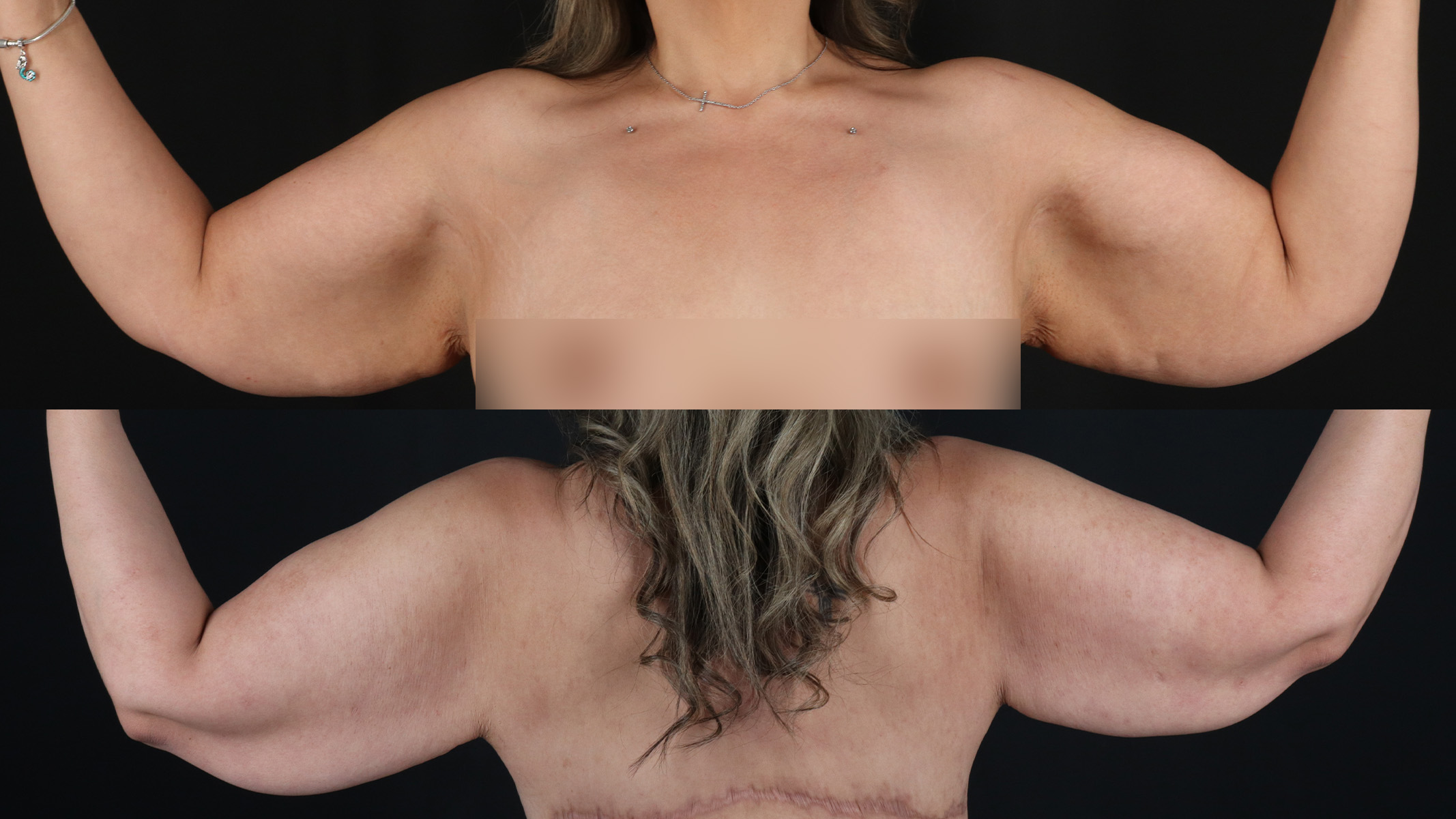 Arm Lift Before & After Patient #4821