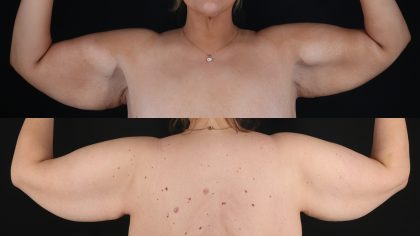 Arm Lift Before & After Patient #4826