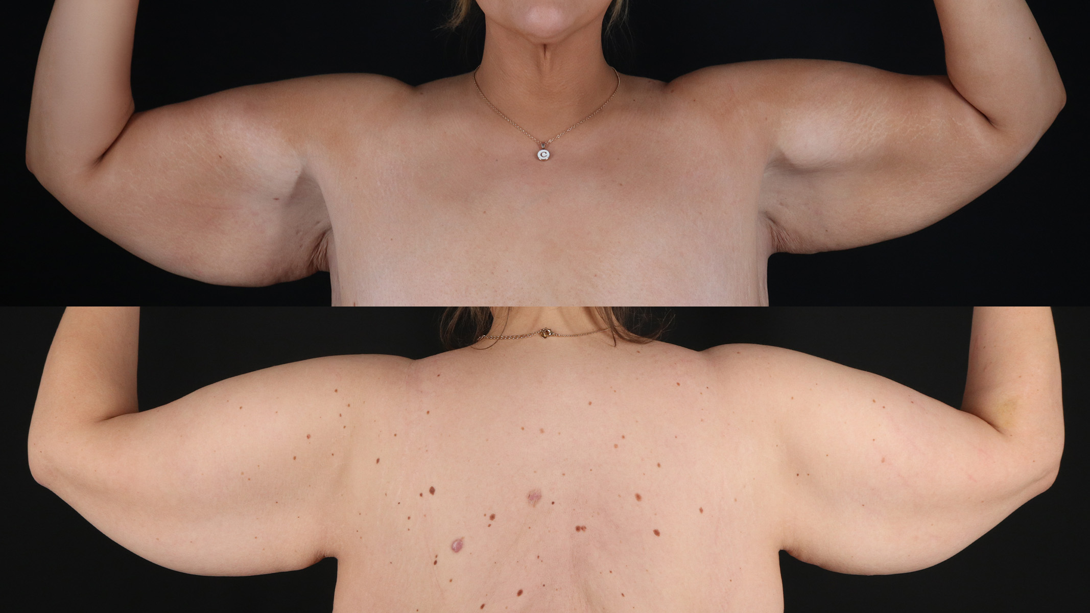 Arm Lift Before & After Patient #4826