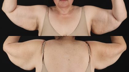 Arm Lift Before & After Patient #4753