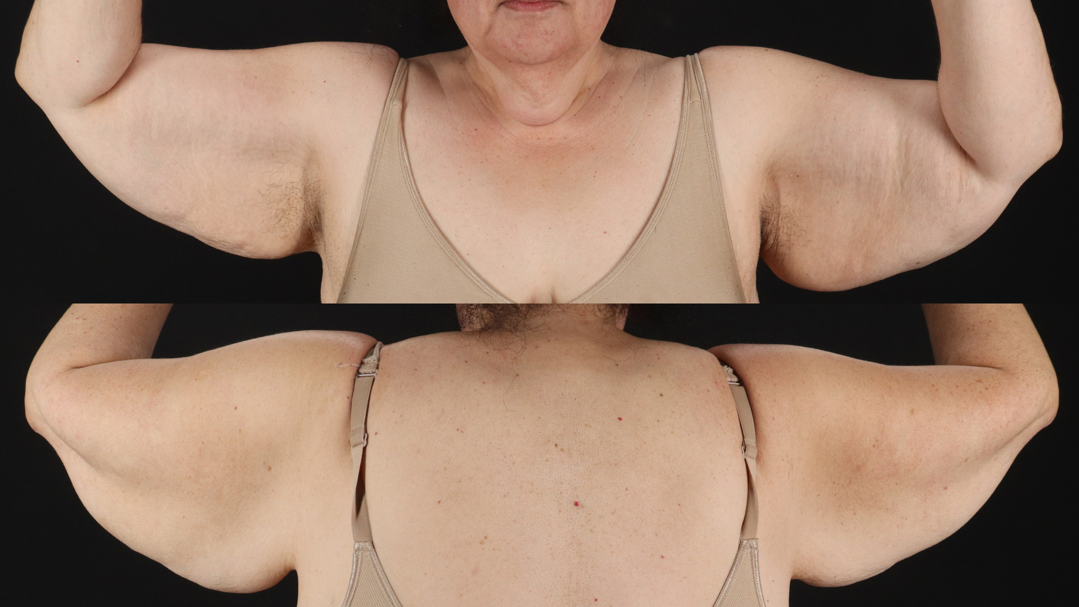 Arm Lift Before & After Patient #4753