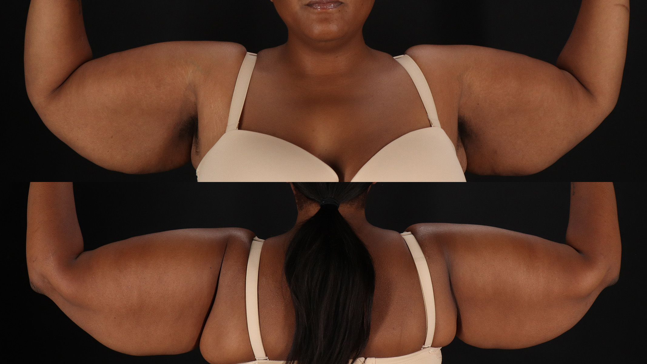 Arm Lift Before & After Patient #4792