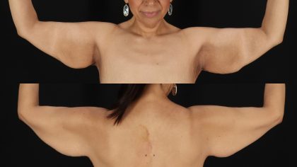 Arm Lift Before & After Patient #4752