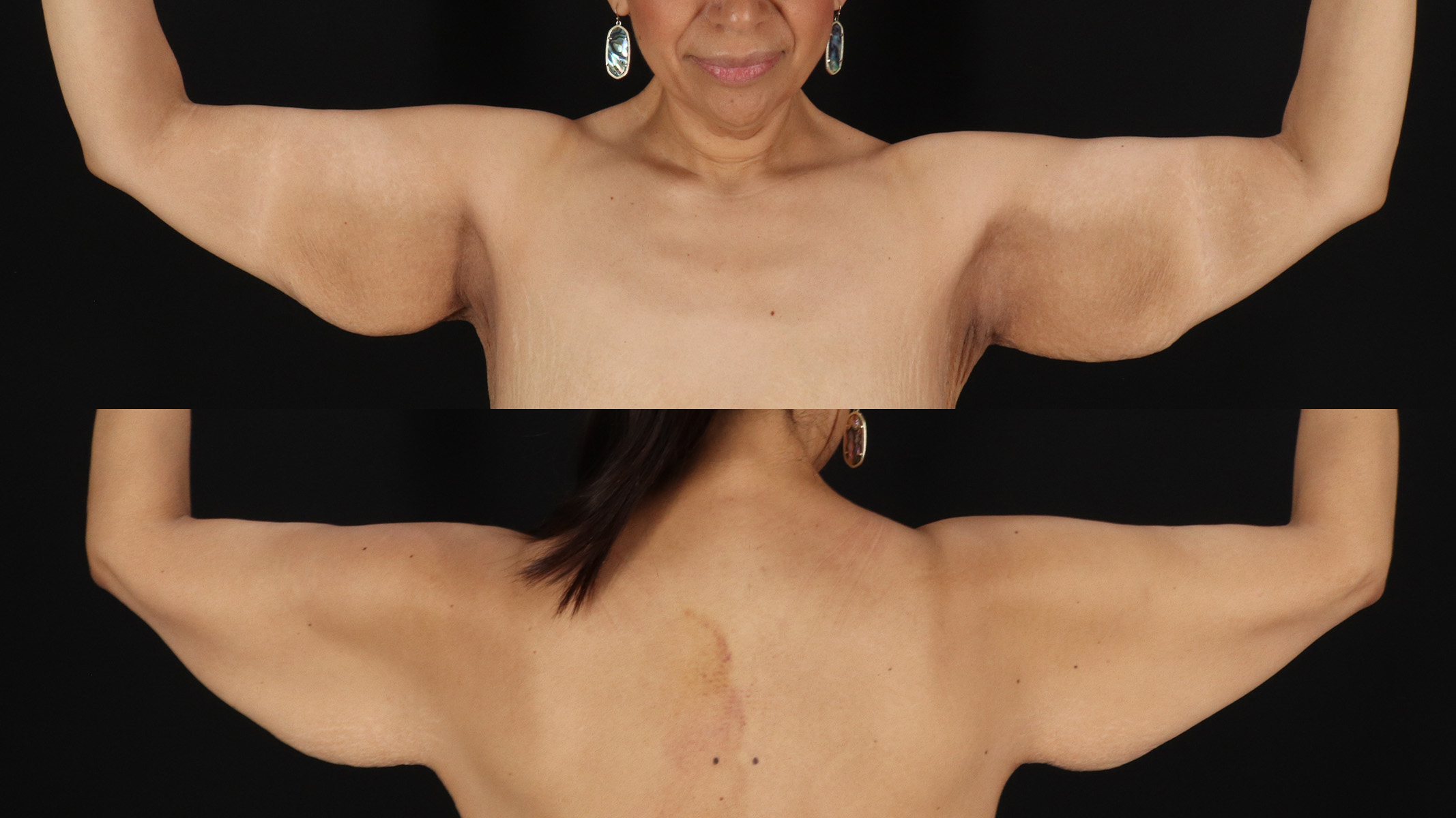 Arm Lift Before & After Patient #4752