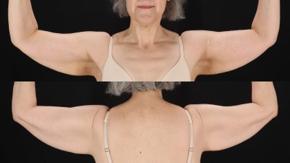Arm Lift Before & After Patient #4788