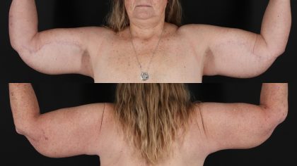Arm Lift Before & After Patient #4755
