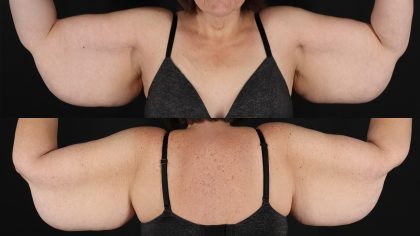 Arm Lift Before & After Patient #4822