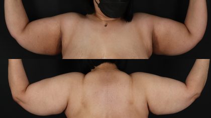 Arm Lift Before & After Patient #4789
