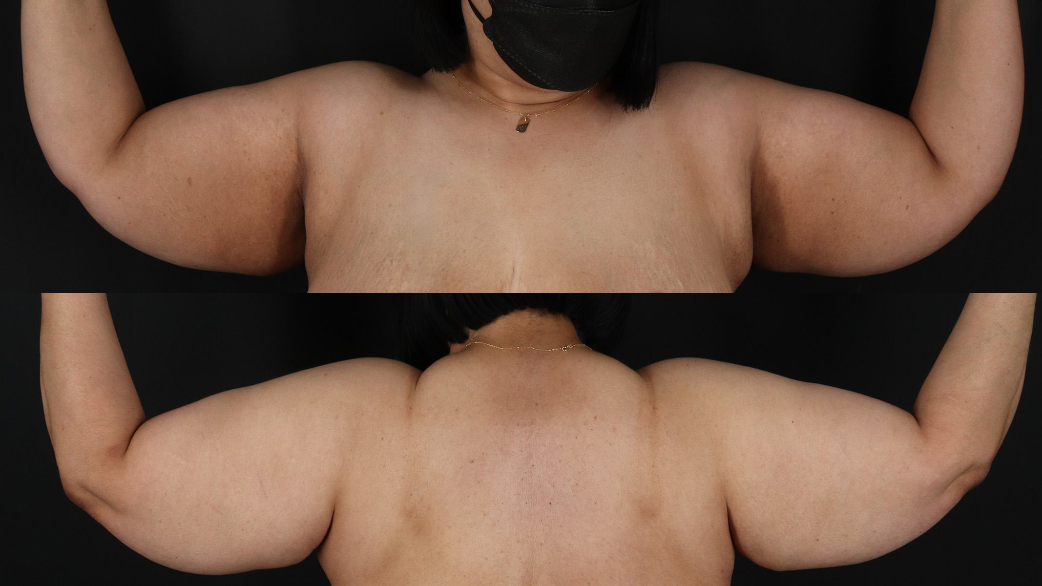 Arm Lift Before & After Patient #4789