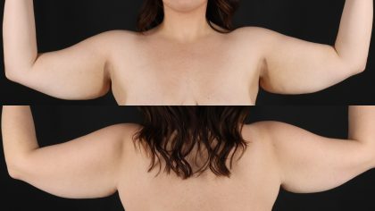 Arm Lift Before & After Patient #4758