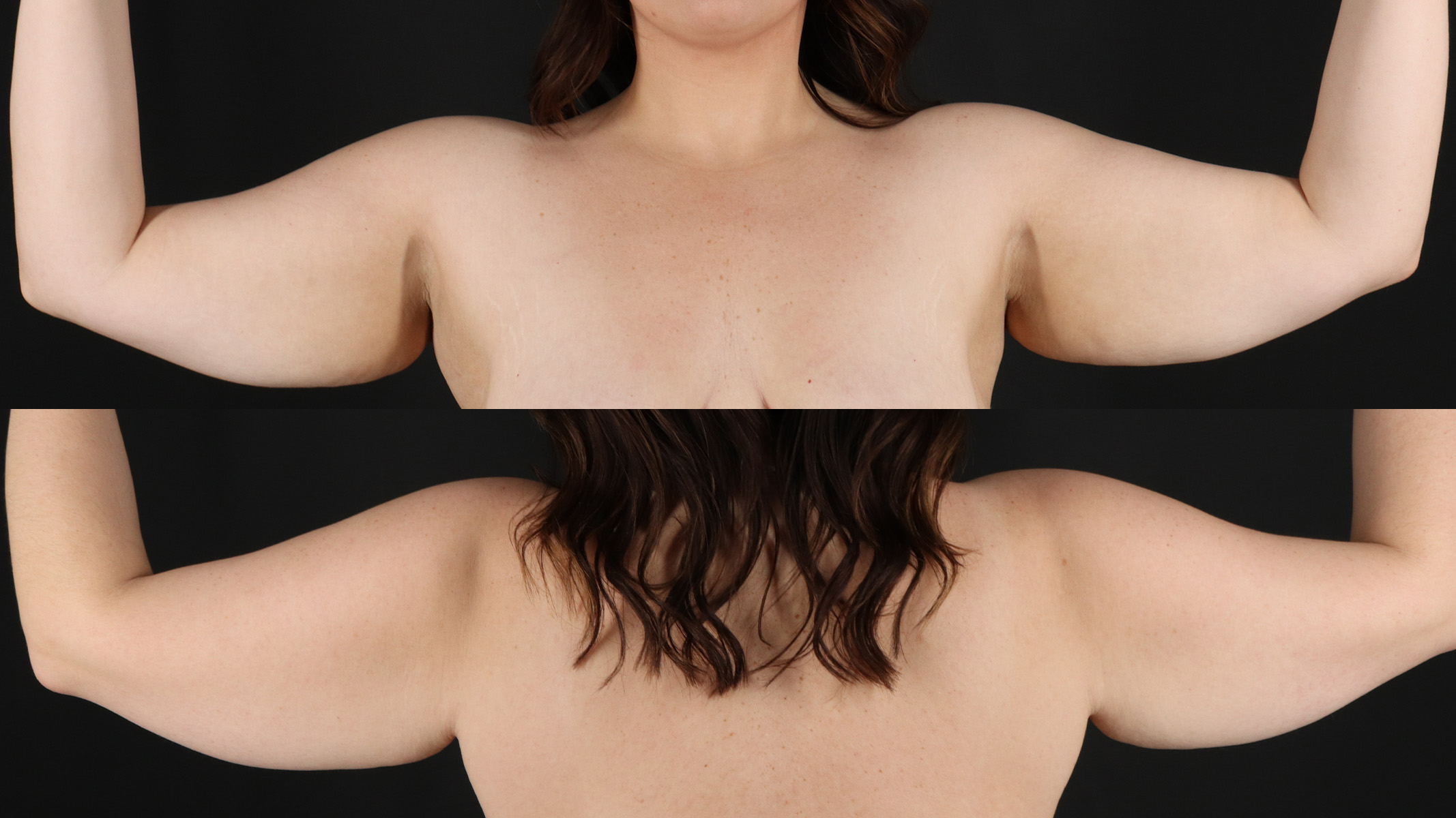 Arm Lift Before & After Patient #4758