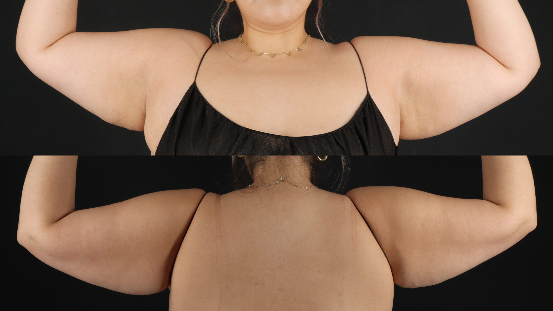 Arm Lift Before & After Patient #4820
