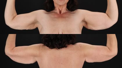 Arm Lift Before & After Patient #4756