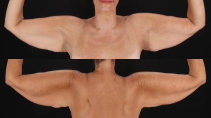 Arm Lift Before & After Patient #4824