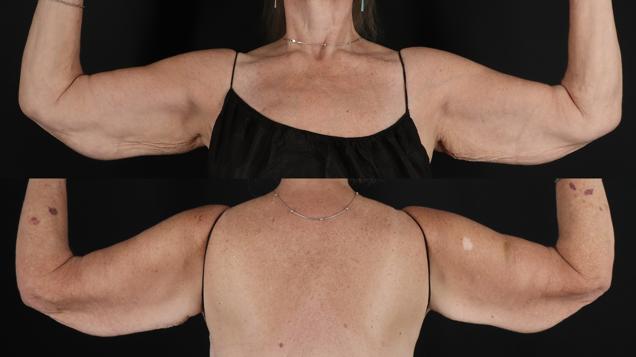 Arm Lift Before & After Patient #4751