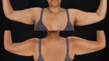 Arm Lift Before & After Patient #4828