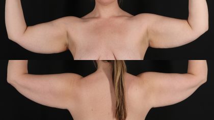 Arm Lift Before & After Patient #4825