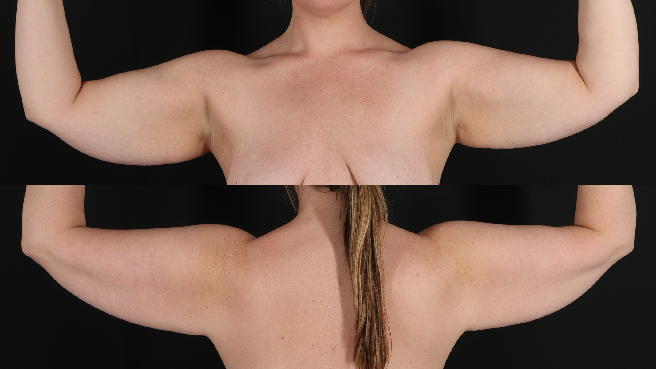 Arm Lift Before & After Patient #4825