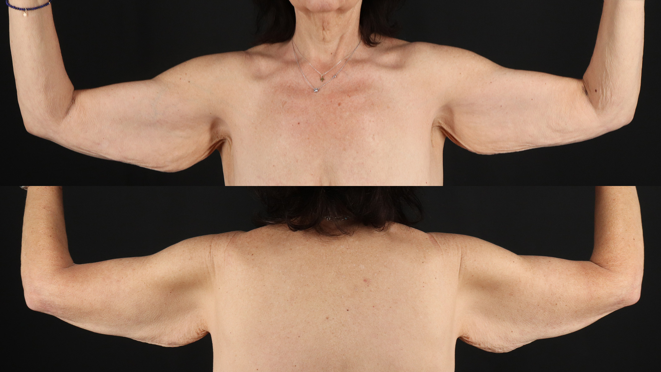 Arm Lift Before & After Patient #4795