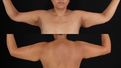 Arm Lift Before & After Patient #4749