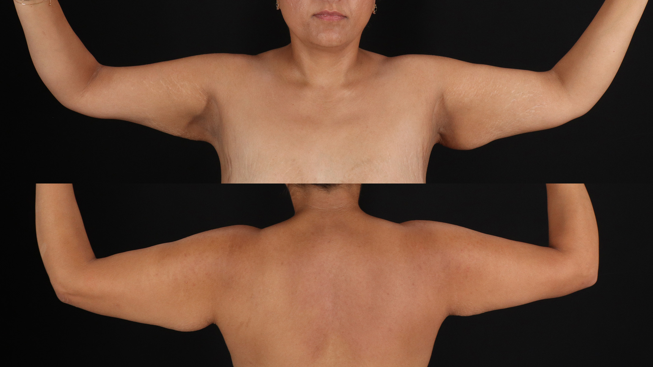 Arm Lift Before & After Patient #4749