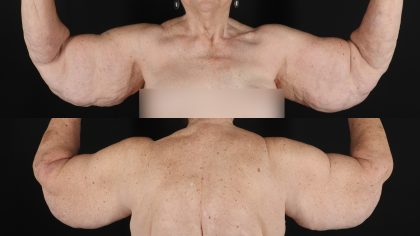 Arm Lift Before & After Patient #4794