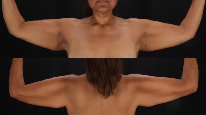 Arm Lift Before & After Patient #4790
