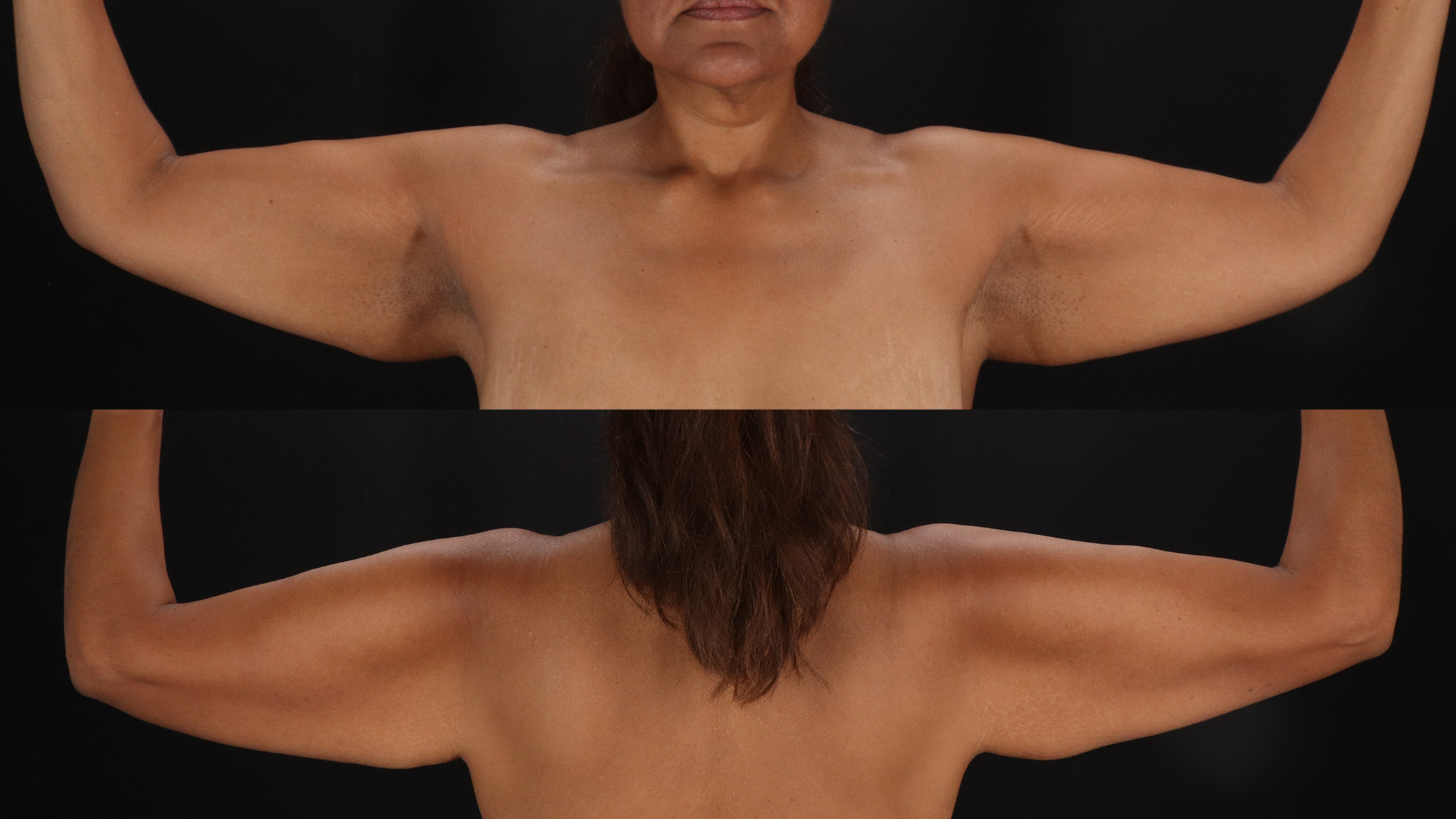 Arm Lift Before & After Patient #4790