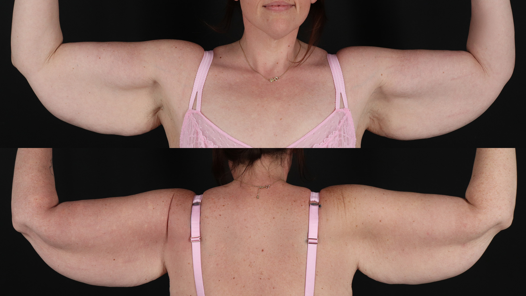 Arm Lift Before & After Patient #4757