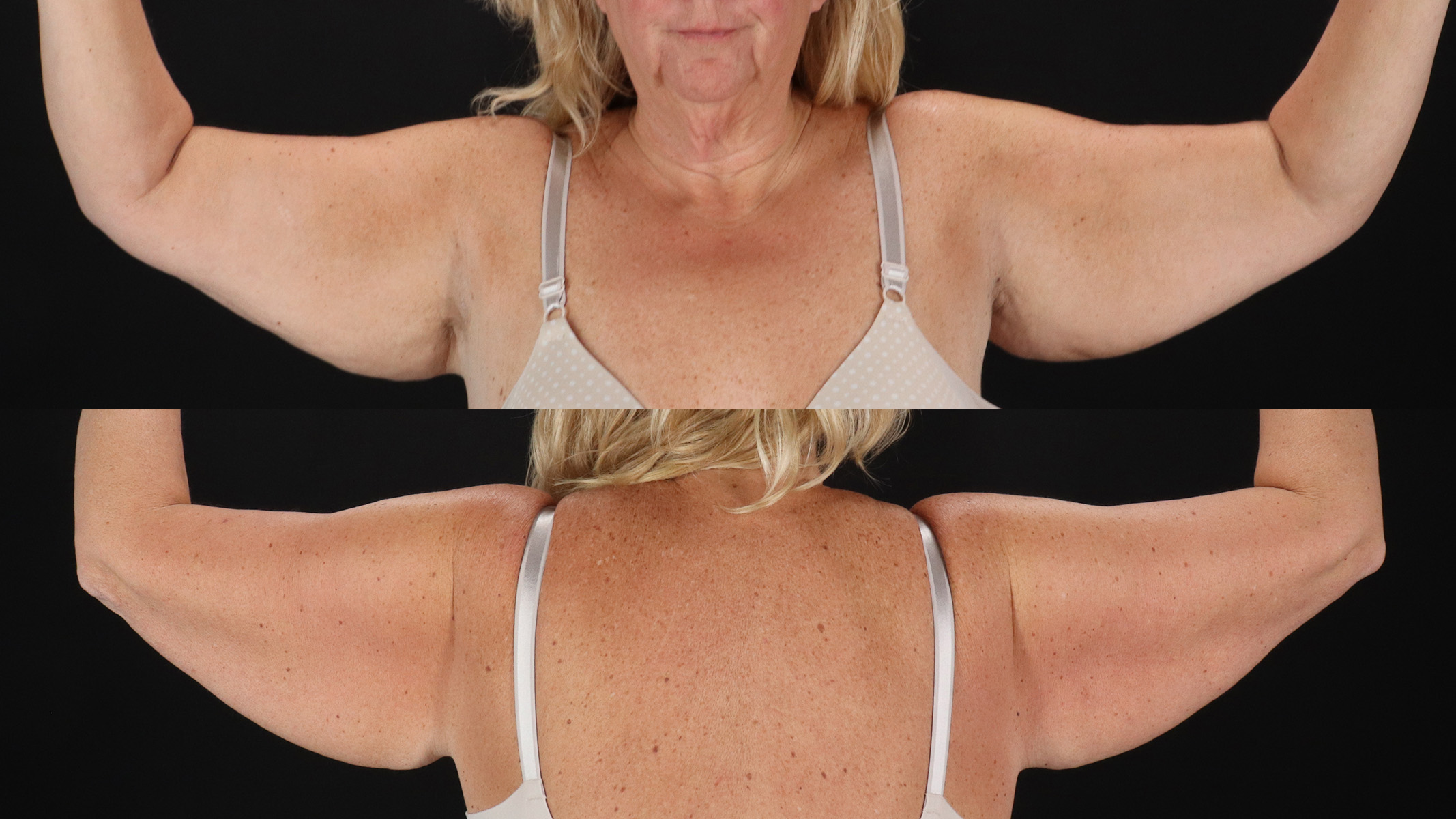 Arm Lift Before & After Patient #4827