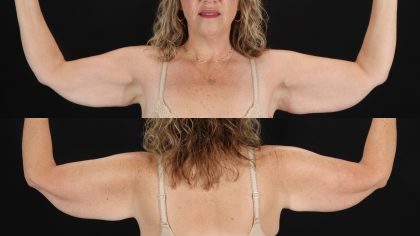 Arm Lift Before & After Patient #4793