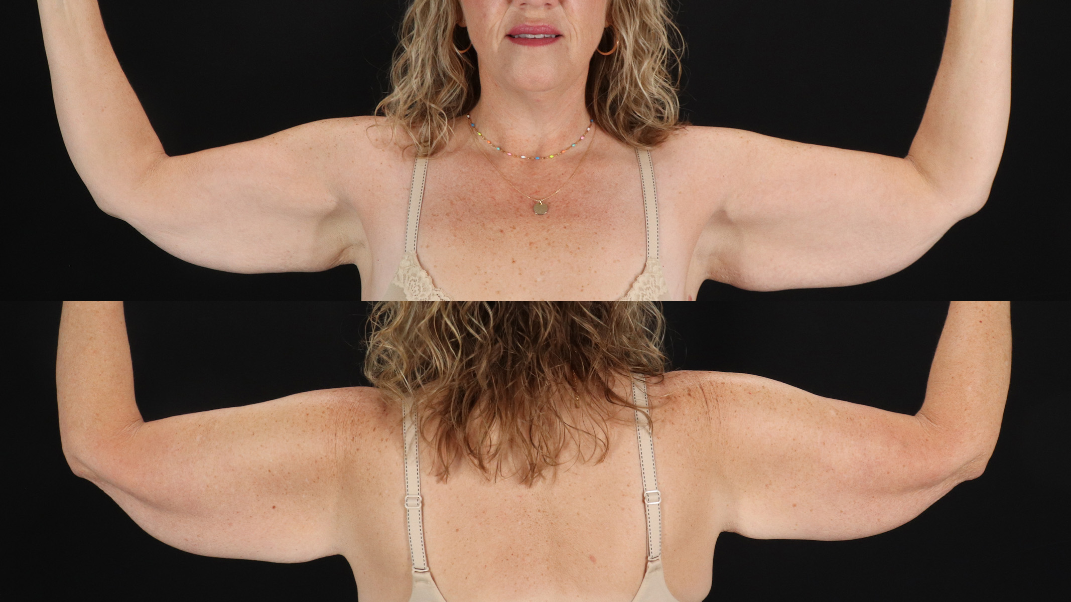 Arm Lift Before & After Patient #4793