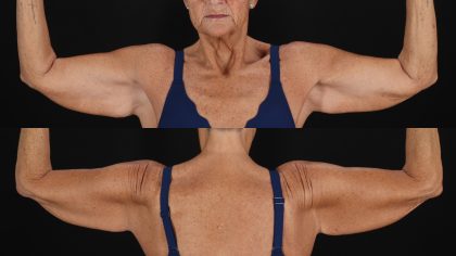 Arm Lift Before & After Patient #4791