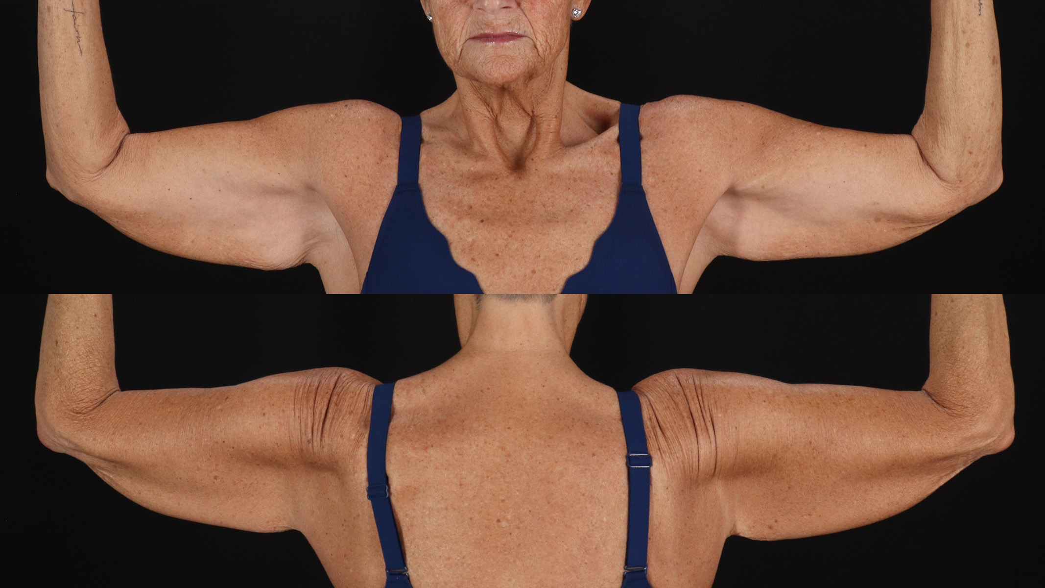 Arm Lift Before & After Patient #4791